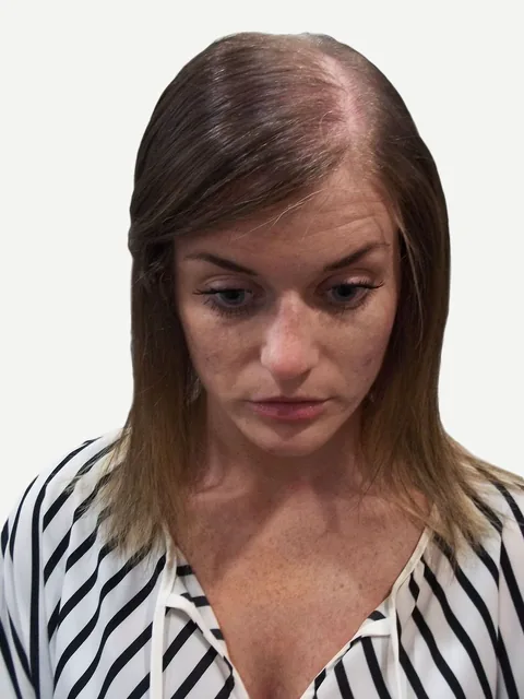 Before: widening part and visible scalp from female pattern hair loss, front view