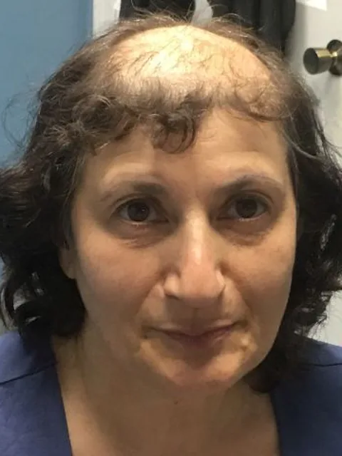 Before: advanced crown and frontal hair loss in a woman over 45