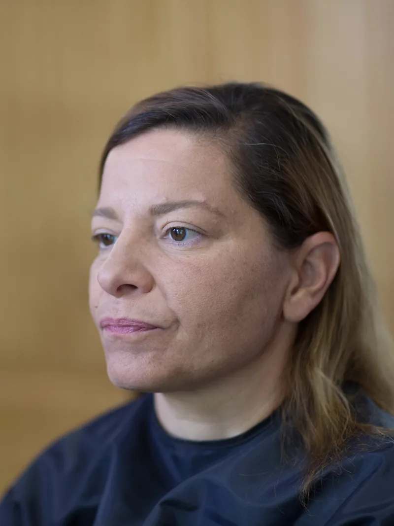 Karen before: fine, thinning hair from female hair loss, at her consultation